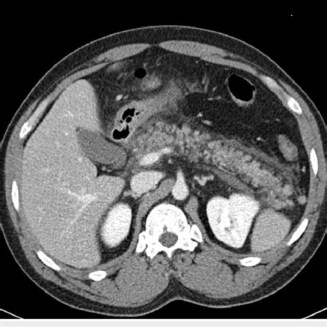 Initial Ct Scan Of The Abdomen Ct Scan Of The Abdomen With Iv Contrast