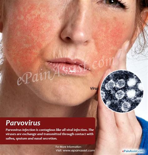 Parvovirus Infection In Humansincubationtransmissionsymptomstreatment