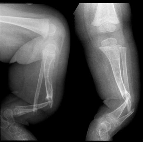 Congenital Pseudarthrosis Of Tibia Bone And Spine