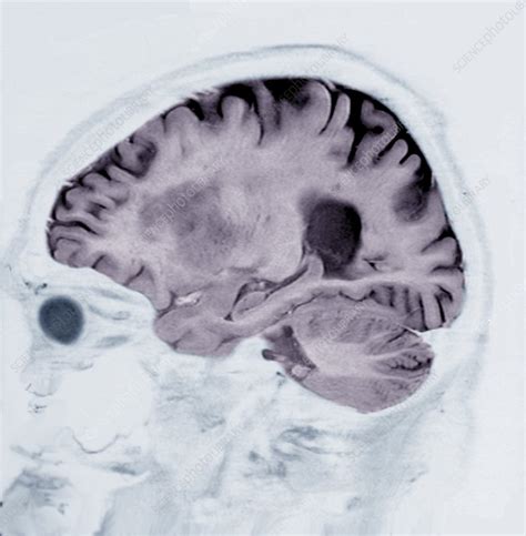 Alzheimers Disease Mri Brain Scan Stock Image C0388635 Science
