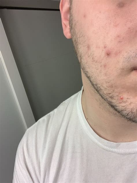 Acne How Did Your 2nd Round Of Accutane Compare To The First Routine
