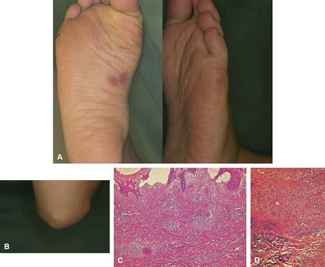 Clinical And Histopathologic Features Of 8 Patients With Microscopic