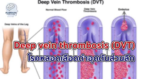 หลอดเลือดดำอุดตัน ส่วนลึกหรือ Deep Vein Thrombosis Dvt เป็นภาวะที่เกิดลิ่