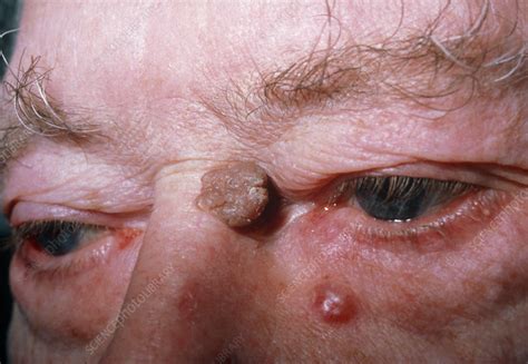 Basal Cell Carcinoma And Seborrhoeic Wart Stock Image M1310138
