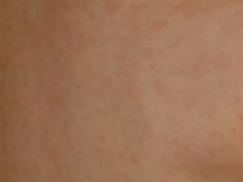 Amoxicillin Rash Symptoms Treatment Pictures Hubpages