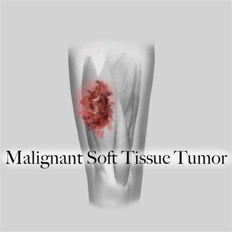 Msk Tumor Therapeutical And Research Center Of Musculoskeletal Tumor