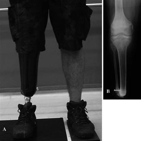 Pdf Cortical Tibial Osteoperiosteal Flap Technique To Achieve Bony