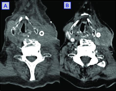 Images Of Ct Scans Showing A Peri Carotid And Left Vocal Cord Lesion
