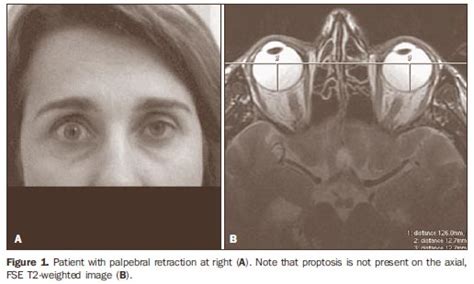 Exophthalmos (also called exophthalmus, exophthalmia, proptosis, or exorbitism). Radiologia Brasileira - Oftalmopatia tireoidea revisitada