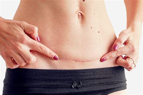 C Section Scar Infection Causes Types Signs And Treatment
