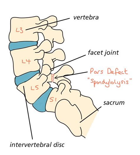 Pars Defect Repair Spines Dorset