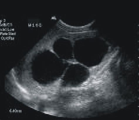 Neonatal Renal Ultrasound