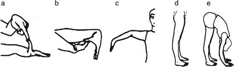 Beighton Scoring System Measures Joint Hypermobility On A 9 Point