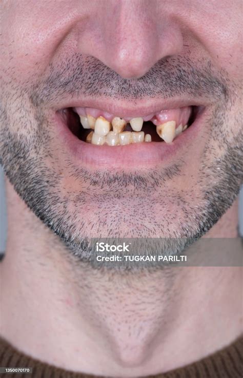 Toothless Adult Man With A Wide Smile Stock Photo Download Image Now