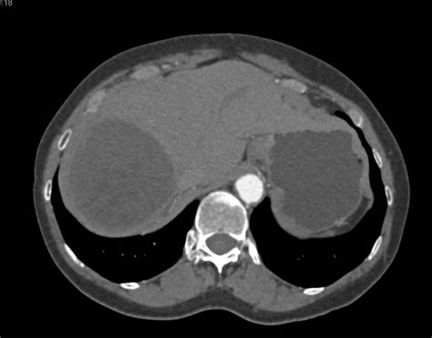 Hydatid Cyst In The Liver See Additional Cyst Or Daughter Cysts Liver