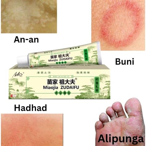 Anti Fungal Cream Mabisa Sa An An Buni Hadhad Alipunga Eczema At