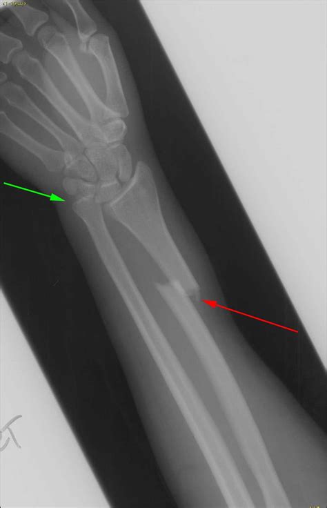 Galeazzi Fracture X Rays Case Studies Ctisus Ct Scanning