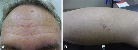 Eruptive Tumors Of The Follicular Infundibulum In Photo Exposed Skin
