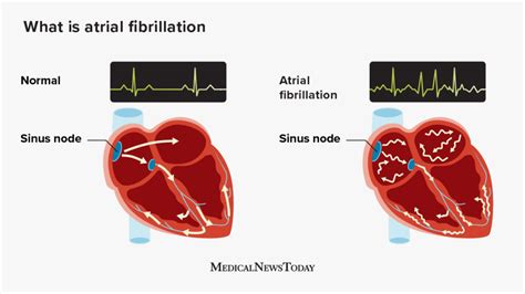 Atrial Fibrillation Symptoms Causes Treatment And More