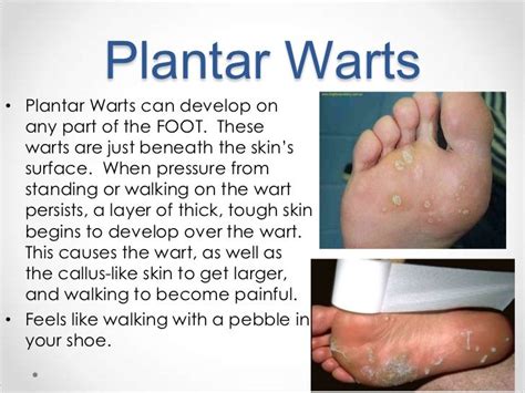 Anatomy Of A Plantar Wart