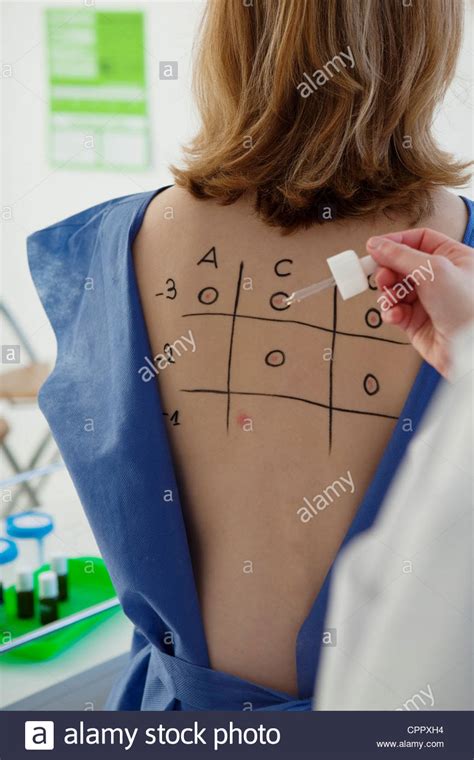Allergy Testing High Resolution Stock Photography And Images Alamy