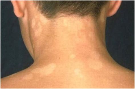 All About Tinea Versicolor Causes Treatment And Prevention
