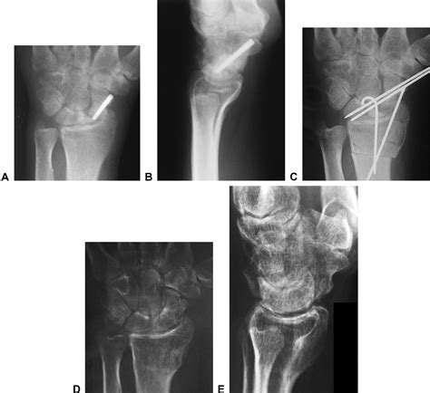 Vascularized Bone Grafting And Distal Radius Osteotomy For Scaphoid