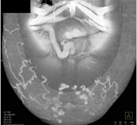 Portal Hypertension With Huge Subcutaneous Collaterals Liver Case