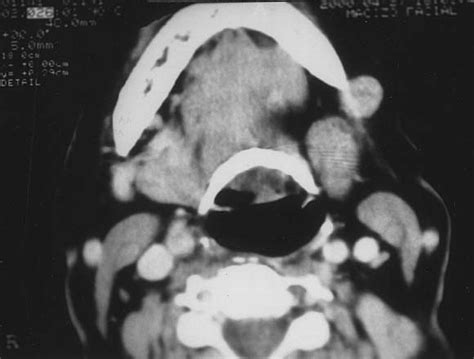 Maxillofacial Nodular Fasciitis A Report Of 3 Cases Journal Of Oral