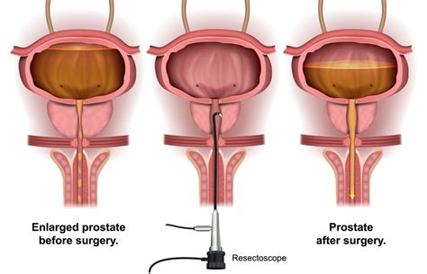 Trans Urethral Resection Of Prostate Turp