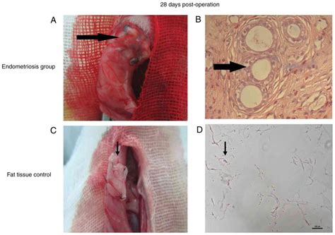 An update in clinical, imagistic features, and management options. lncRNA/mRNA profiling of endometriosis rat uterine tissues ...