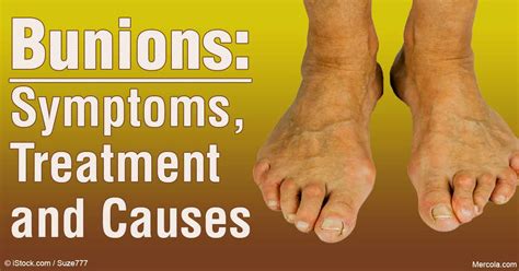 Bunions Causes Symptoms And Treatment