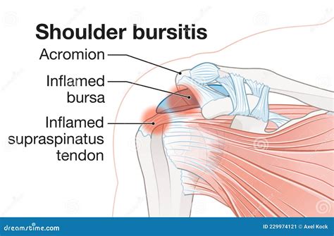 Shoulder Bursitis Inflamed Bursa And Supraspinatus Tendon Stock Image
