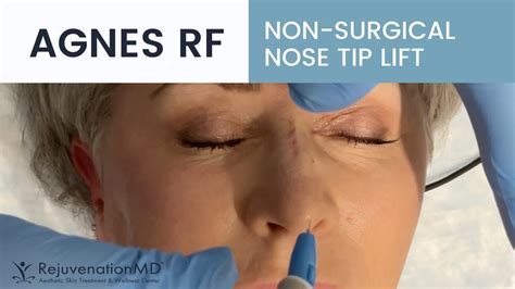 Non Surgical Nose Tip Lift Youtube