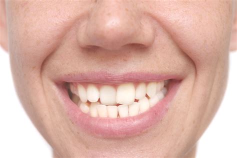 Crooked Teeth Tmj Disorders Philadelphia Pa Dr Bruce Wilderman