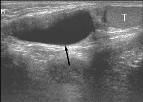 Sonographic Findings Of Groin Masses Yang 2007 Journal Of