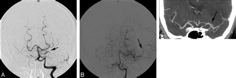 Intra Arterial Thrombolysis Of Occluded Middle Cerebral Artery By Use Of Collateral Pathways In