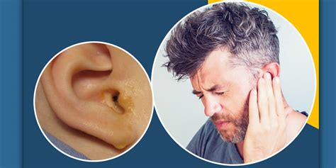 Yellow Discharge From Ear Causes And Treatment कान से निकलता है पीला