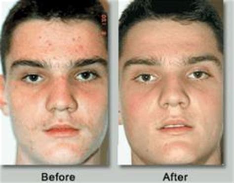 What are the best products for cystic acne? How to Get Rid of Acne Scars