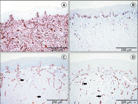 A Immunohistochemical Ihc Stain For Vimentin Showing A Strong Download Scientific Diagram