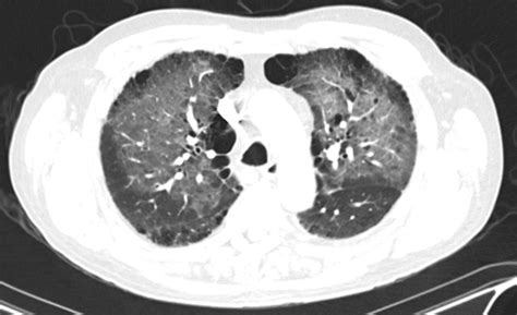 Cureus Organizing Pneumonia Secondary To Pulmonary Actinomycosis A