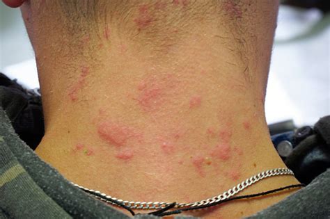 Red Skin Rash On The Neck Allergic Reaction On Skin Stock Photo
