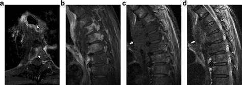 A Postcontrast Axial T1 Weighted Mri With Fat Suppression Reveals An