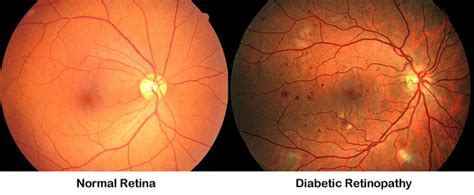 What Is Included In A Diabetic Eye Exam Diabeteswalls