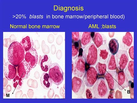Acute Lymphoblastic Leukemia Bone Marrow Biopsy