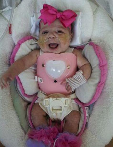 Baby Born With Heart Outside Her Body Ready To Leave Hospital Ny