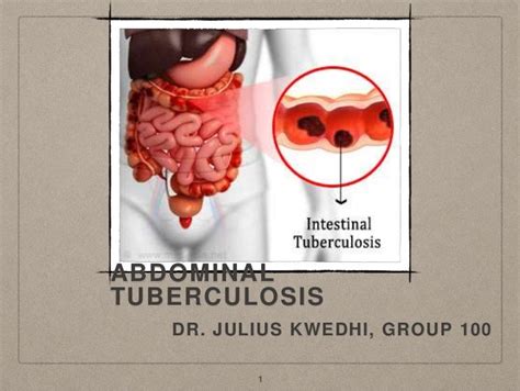 Abdominal Tuberculosis Dr Julius King Kwedhi