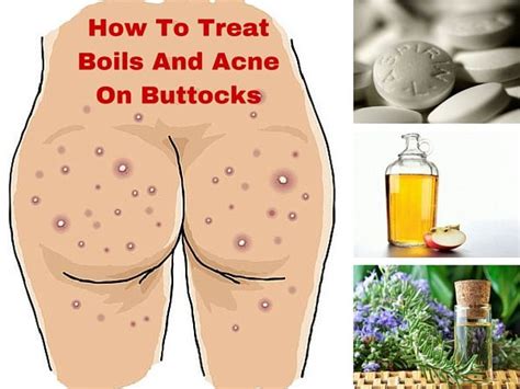 Treatment for herpe symptoms burning itching bumps on private area? answered by a verified doctor: Know about the home remedies for boils on private areas ...