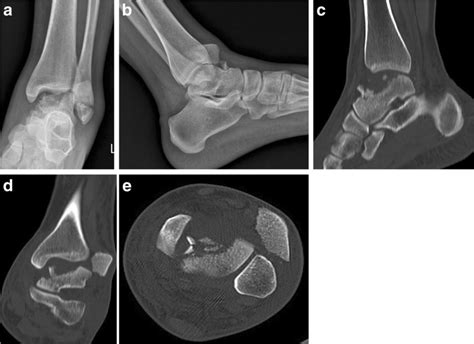 A Big Displaced Partial Talar Body Fracture In Association With Lateral