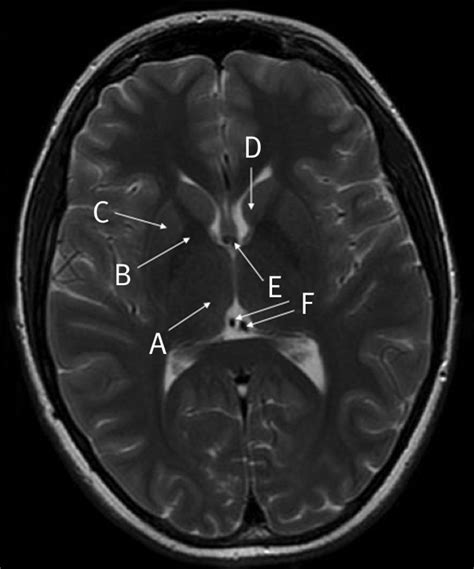 Anatomy Of The Brain T2 Weighted Magnetic Resonance Image Axial